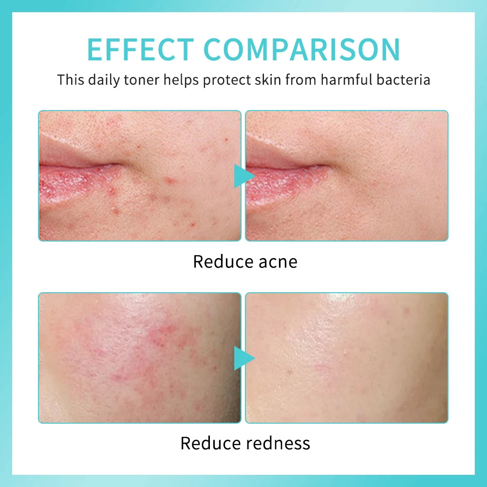Sencture Calm Mist — Hypochlorous Acid Skin Spray for Redness, Acne & Sensitive Skin