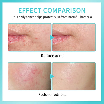 Sencture Calm Mist — Hypochlorous Acid Skin Spray for Redness, Acne & Sensitive Skin
