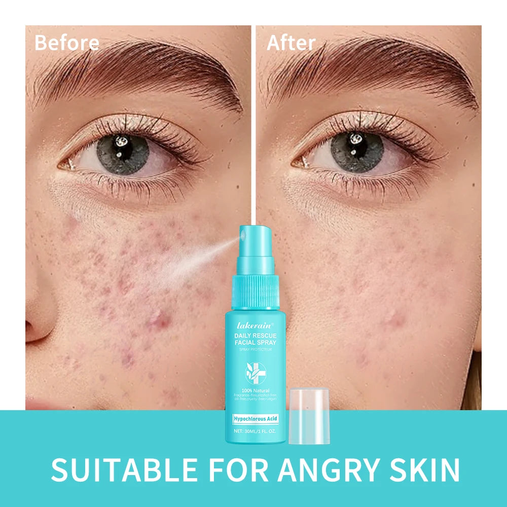 Sencture Calm Mist — Hypochlorous Acid Skin Spray for Redness, Acne & Sensitive Skin